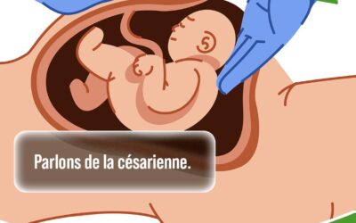 La césarienne