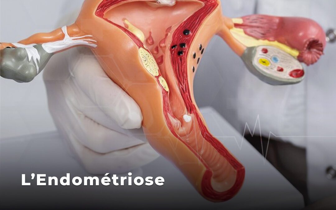 L'endométriose