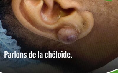 Cheloïde – Quand la cicatrice prend le dessus
