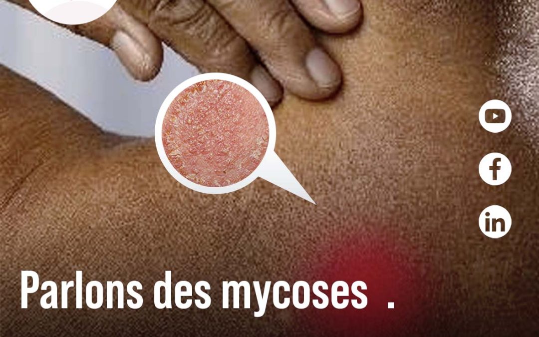 Parlons de Mycoses